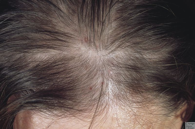 Perte de Cheveux - Alopécie Diffuse - Om Signature Clinique Médico-Esthétique